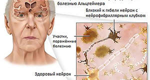 Антибиотики могут быть эффективными для замедления болезни Альцгеймера