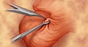 Хирургическая контрацепция для мужчин