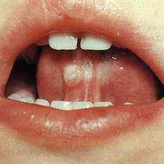 Коррекция дисбиотических изменений при заболеваниях слизистой оболочки рта