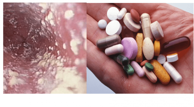 Молочница после антибиотиков: механизм появления, профилактика и инструкция по ликвидации