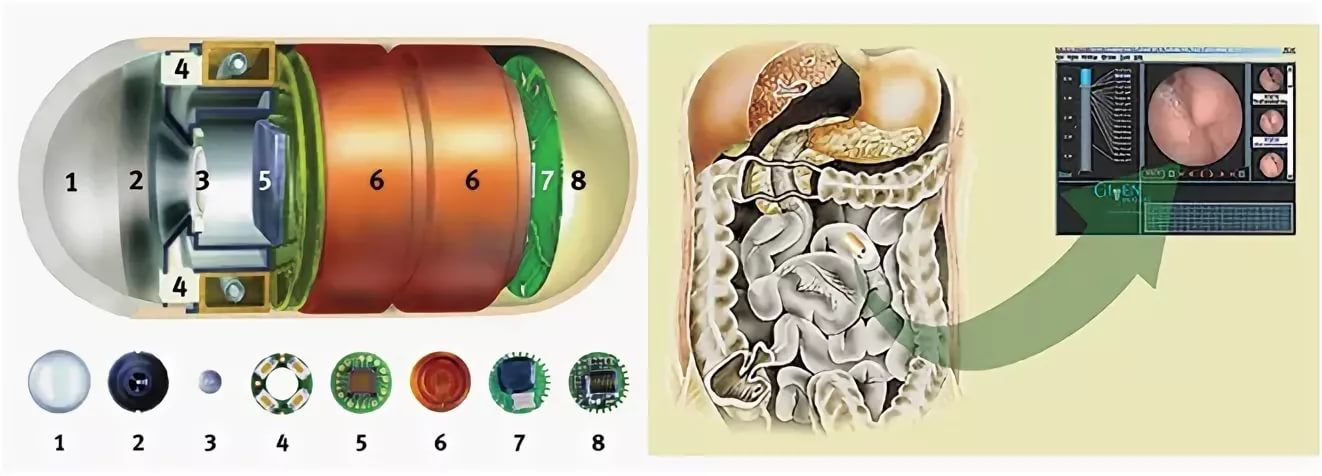 Капсульная эндоскопия фото