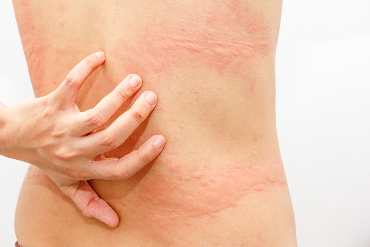 Нейродермит связан с нарушением микробиома кожи