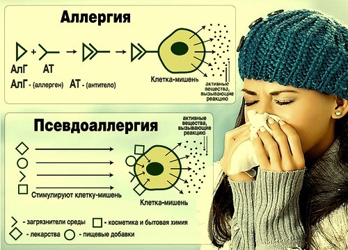 Способ лечения псевдоаллергии