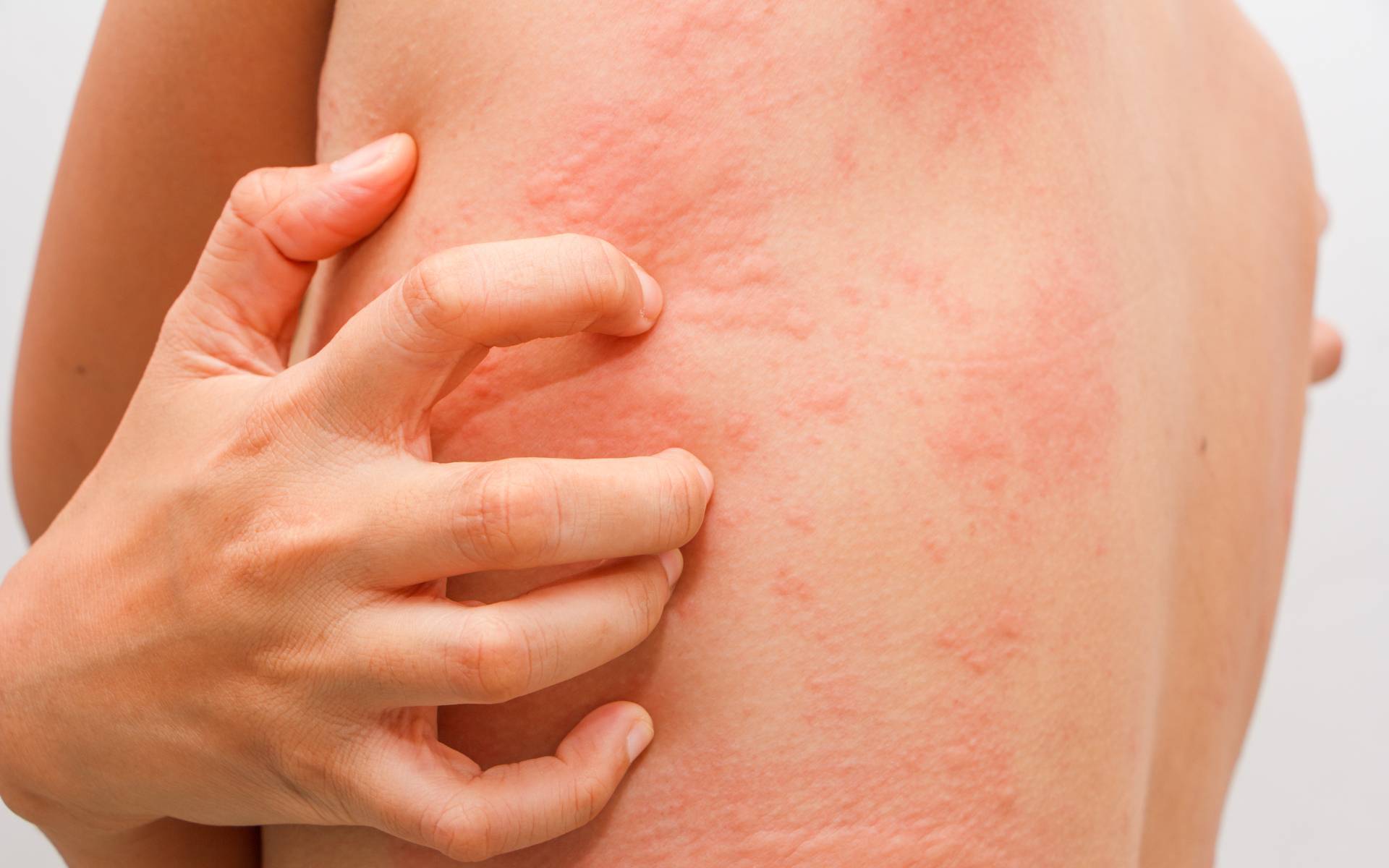 Дисбактериоз - одна из причин аллергии
