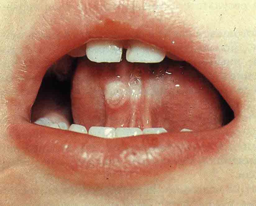 Коррекция дисбиотических изменений при заболеваниях слизистой оболочки рта